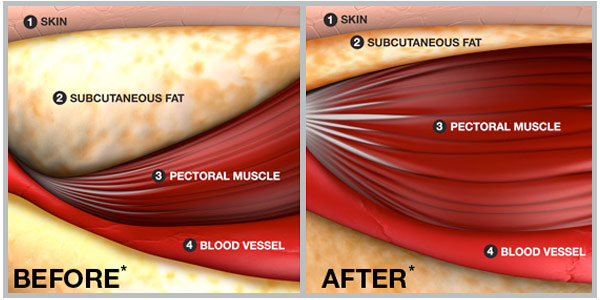 subcutaneous fat before and after